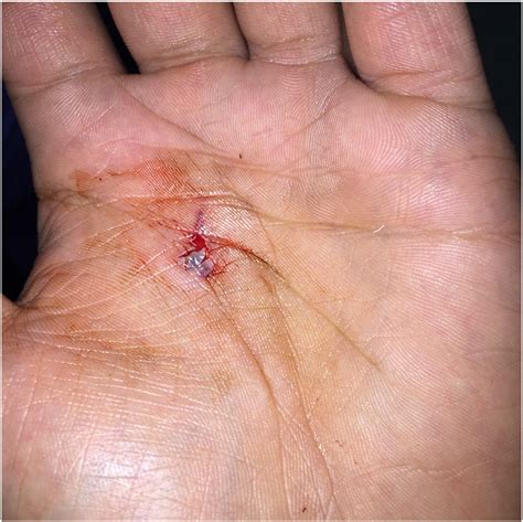 Left hand open wound icd 10. Things To Know About Left hand open wound icd 10. 
